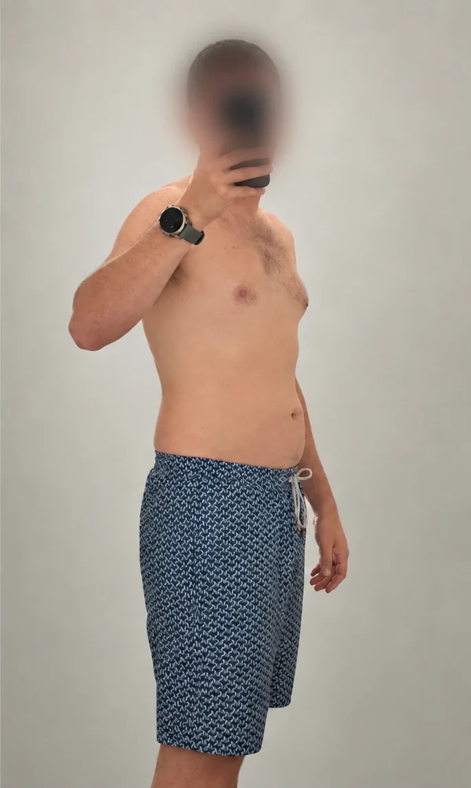 A.B., 36, after losing 30 pounds. Face blurred at his request.