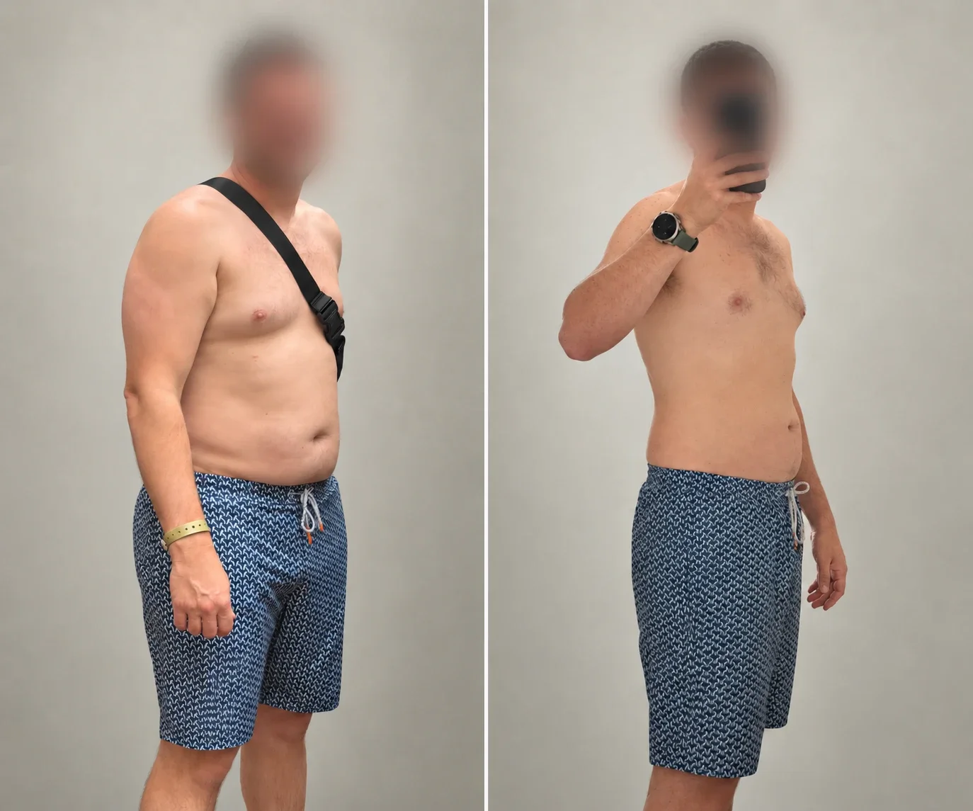 A.B., 36, before and after coaching, side by side. Face blurred at his request.